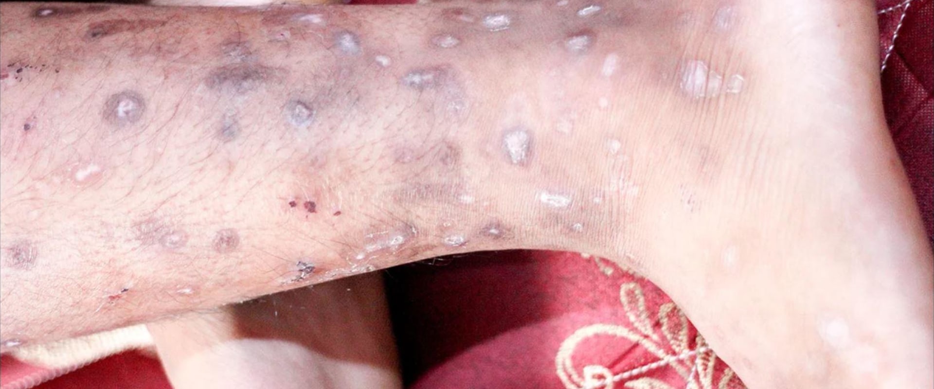 Understanding Skin Infections and How to Treat Them