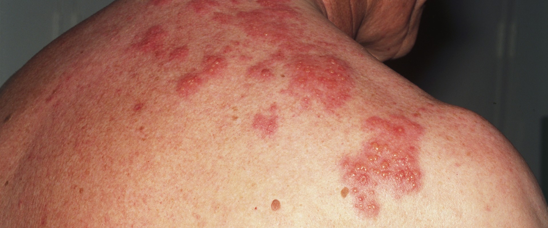 Risks Associated with the Shingles Vaccine