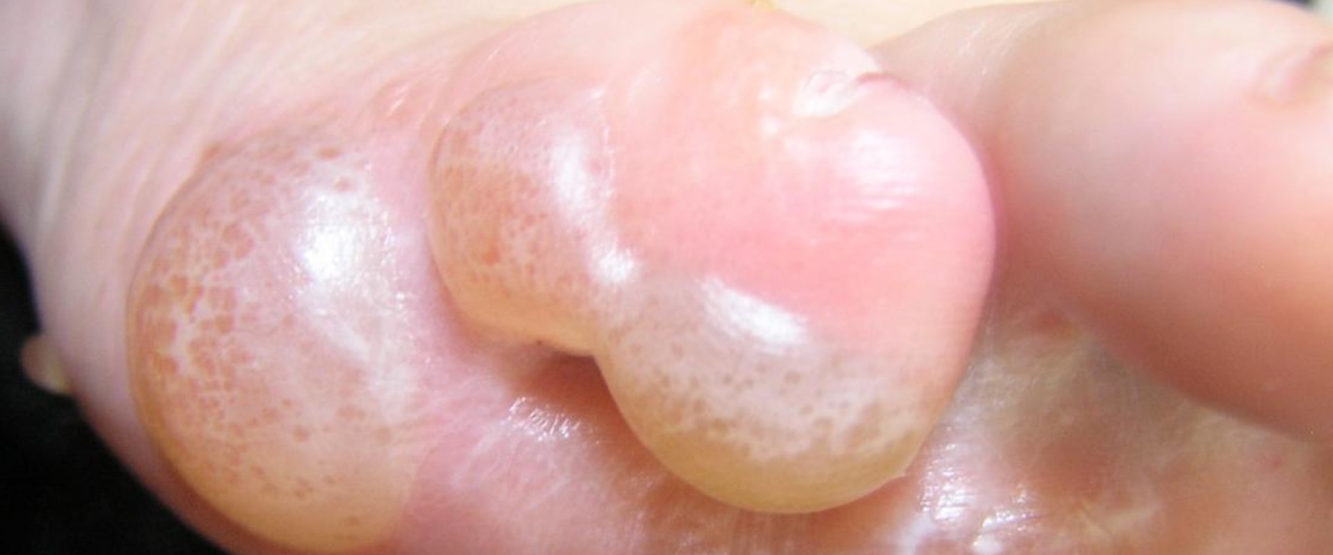 Blisters: What You Need to Know