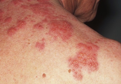 Risks Associated with the Shingles Vaccine