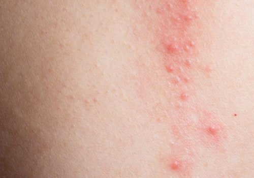 Exploring Itching: What Causes It and How to Treat It